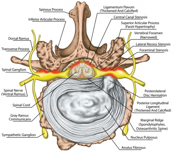 lumbar spinal stenosis.jpg